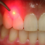 red laser diode system treating the gumline in a patients mouth